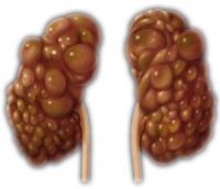 Kidney failure