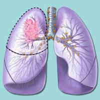 Lung cancer