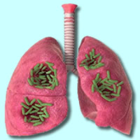 Lung infection