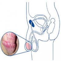 Male candidiasis