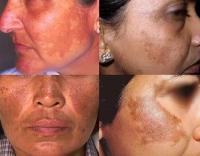 Melasma