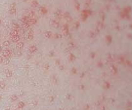 miliaria rubra treatment