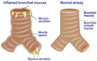 Mucosal edema