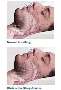 Normal and apnea sleep