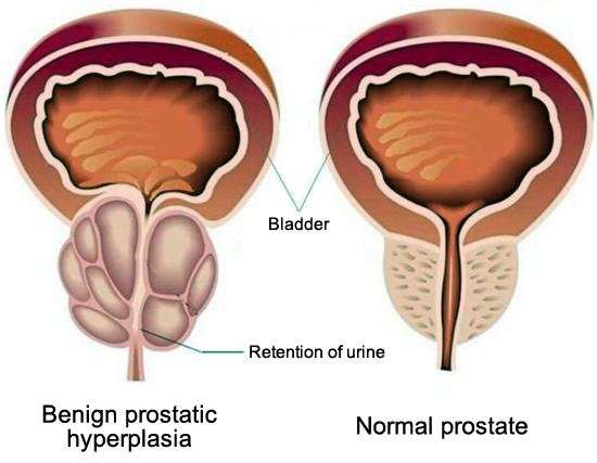 what's the main cause of prostate tissues issues