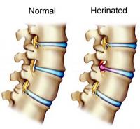 Normal and herniated disk