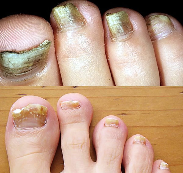 Nail Fungus - Causes, Symptoms and Treatment