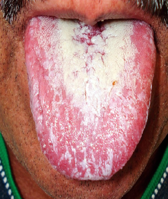 Candidiasis Oral Thrush 36