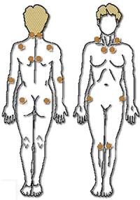 Pain points of fibromyalgia