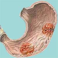 Peptic ulcer