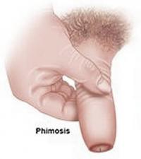 Phimosis
