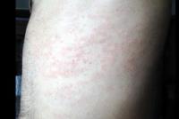 Pityriasis rosea rash