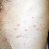 Pityriasis Rosea