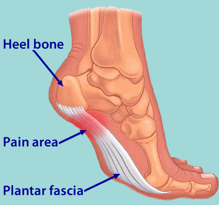 Pain Under The Heel