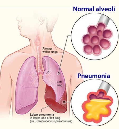 PNEUMONIA - Risk Factors, Symptoms, Diagnosis and Treatment