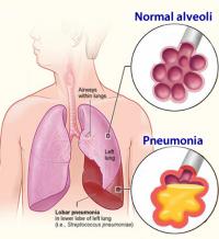 Pneumonia