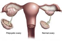 Polycystic and normal ovary