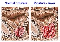 Prostate cancer