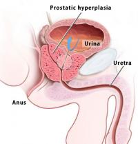 Prostatic hyperplasia