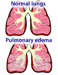 Image result for pulmonary edema