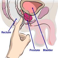 Rectal examination