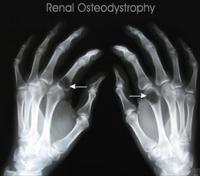 Renal osteodystrophy