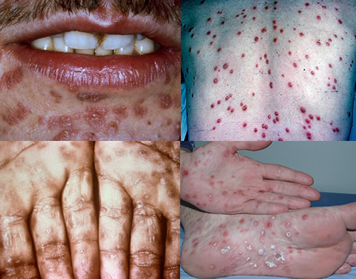 梅毒の第2期の症状に関する写真_バラ疹