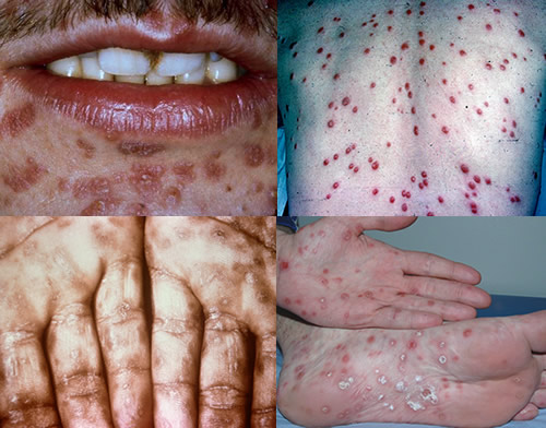 Palm Skin Rash Types, Causes, Pictures, Treatment ...