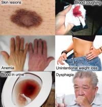 Signs and symptoms of cancer
