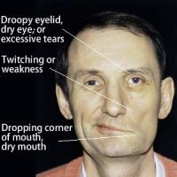 Signs of facial paralysis