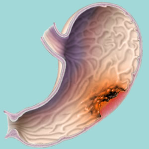 Dyspepsia - Symptoms of Upset Stomach