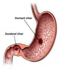 Stomach ulcer and duodenal ulcer