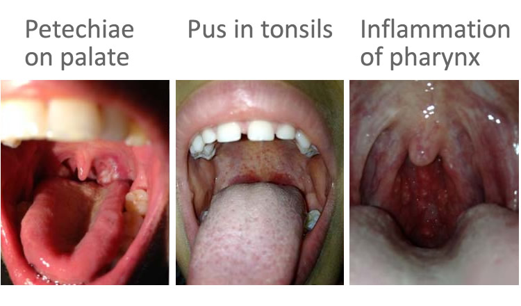 Streptococcal Infections | Strep Throat | MedlinePlus