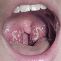 Streptococcus pharyngitis