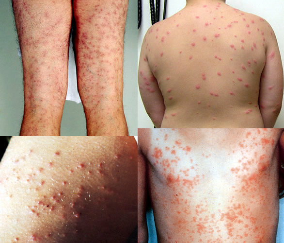 swimmers itch on feet swimmers itch on feet