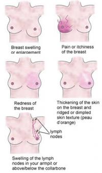 Symptoms of breast cancer