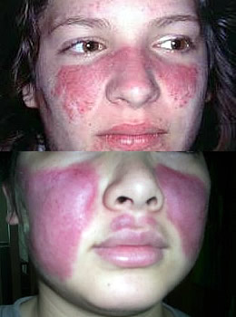 Download this Symptoms Lupus picture