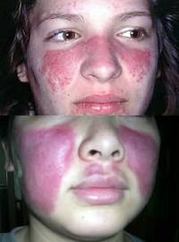 Symptoms of lupus