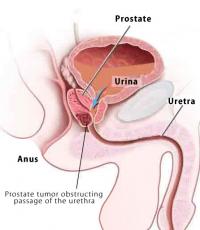 Symptoms of prostate