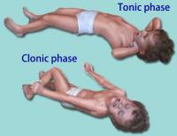 Tonic-clonic phase