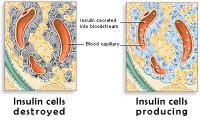 Type 1 diabetes