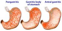 Types of gastritis