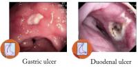 Ulcer