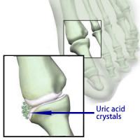 Uric acid crystals