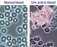Uric acid in blood