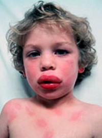 Urticaria and angioedema