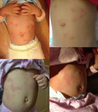 Urticaria