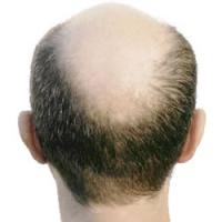 Alopecia