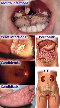 Candida fungus