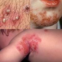 Folliculitis, cellulitis, impetigo